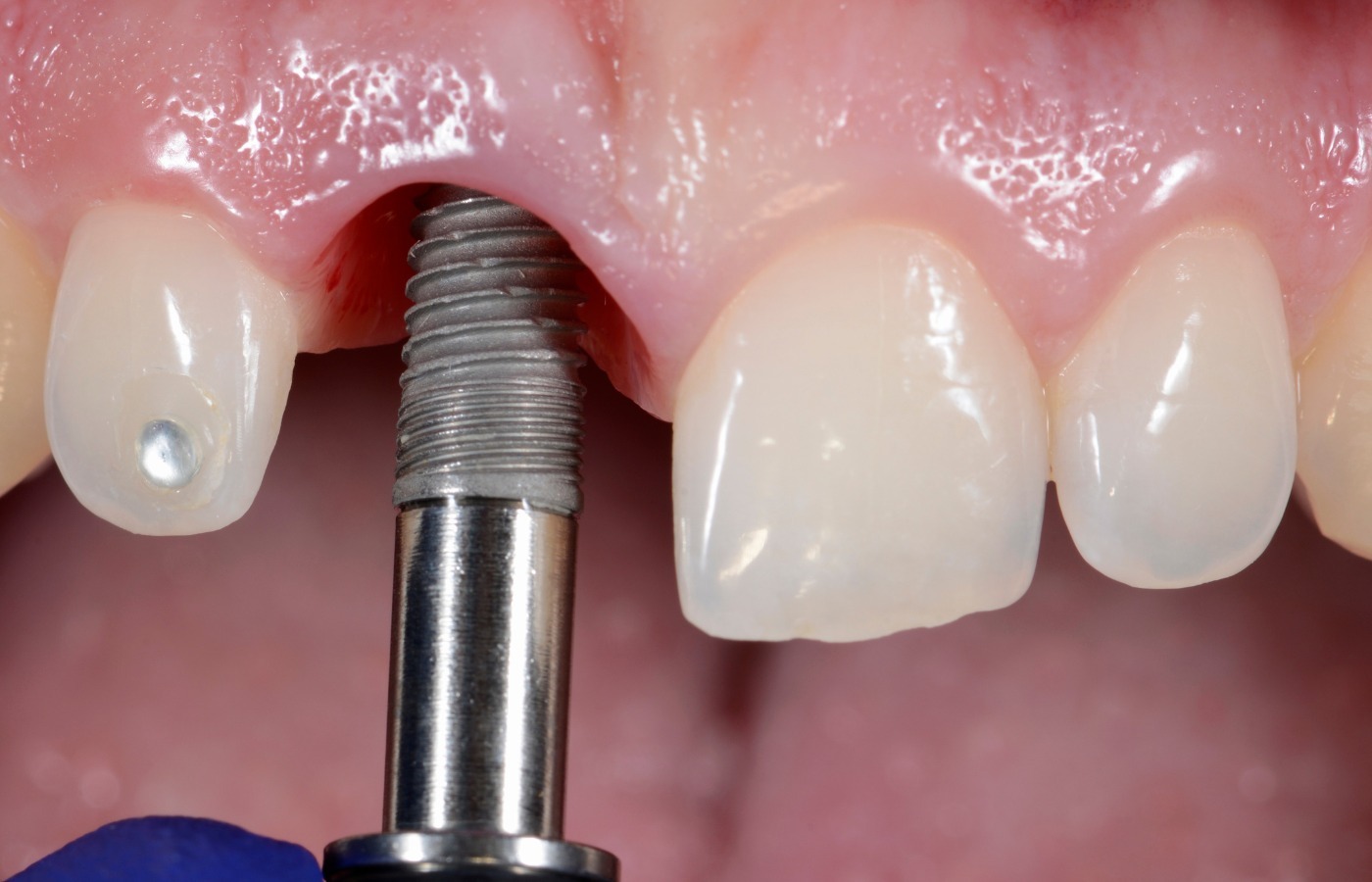 dental implant benefits